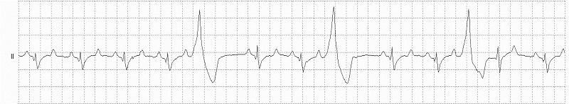 Ventricular trigeminy Rhythm Strip